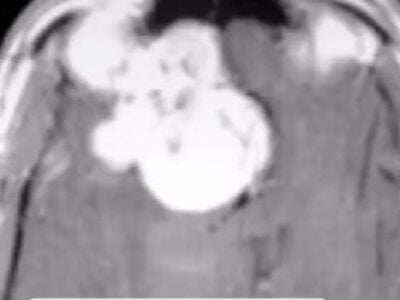 Мужчина превратился в педофила из-за опухоли в мозгу 25 85183229