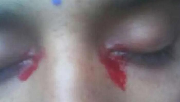 Женщина заплакала кровавыми слезами 18 65180486