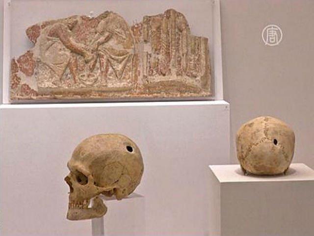 Drevnie greki sverlili cherepa i lechili travami