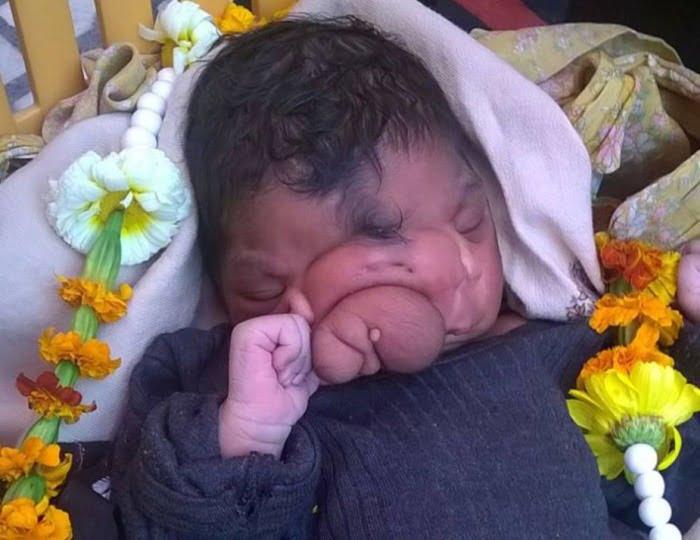 После удаления врожденного «хобота» девочка из Индии осталась с двумя носами 18 44305067