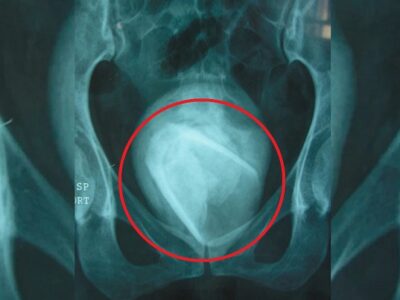 Врачи были шокированы, найдя в мочевом пузыре стеклянный стакан, который пробыл там 4 года 23 05643529