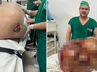 Из живота женщины вырезали 45-килограммовую опухоль 20 88450628